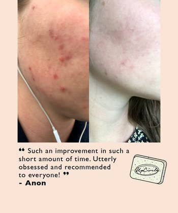 side by side before and after images of someone with acne who then has clear skin