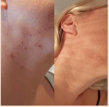 Reviewer before and after image with acne lessened after using the face scrub 