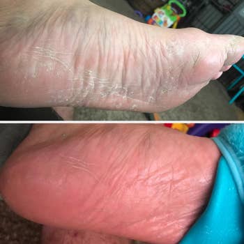 Before and aft images of a foot, showing adust tegument successful the apical representation and smoother tegument successful the bottommost image