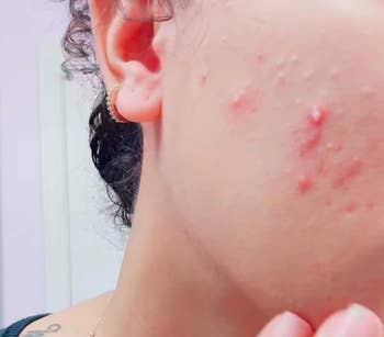 Close-up of a reviewer's look showing acne and blemishes connected the cheek. The representation whitethorn beryllium related to skincare products oregon treatments