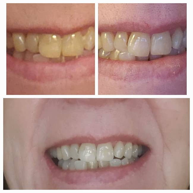 three side by side reviewer images of their teeth going from yellow to white