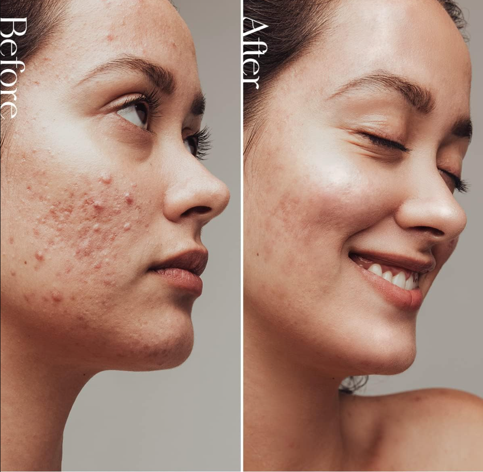 Side-by-side comparison of a model's skin before and after treatment, showing clear improvement