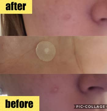 reviewer before during and after photo of the acne patch helping their pimple