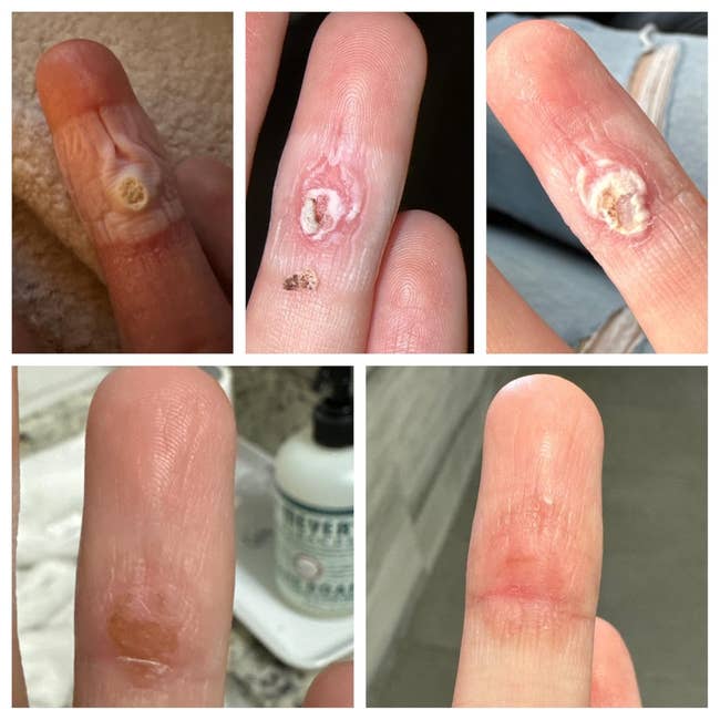 Close-up of a finger in different stages of healing from a wart