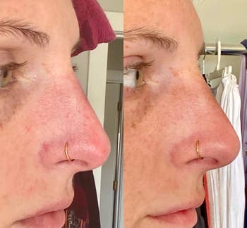 b&a of side of reviewer's nose with red spots (left) and same nose with less red spots (right)