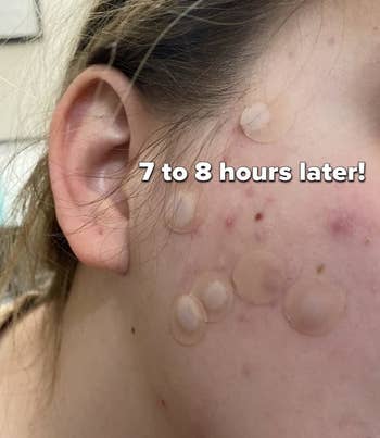 same reviewer with pimple patches on their face and showing some of them filled with pus 7 to 8 hours later