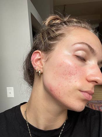 reviewer showing their look   earlier  with a batch  of reddish  spots