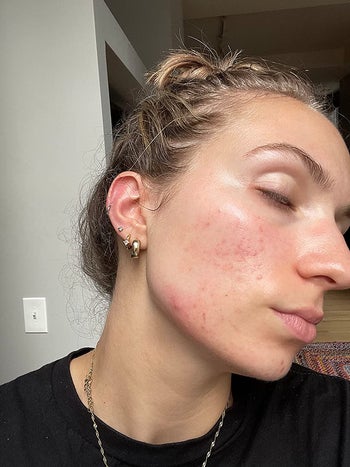 reviewer showing their face before with a lot of red spots