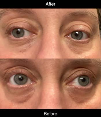 another reviewer's before and after wearing under eye patches showing significantly lighter dark circles
