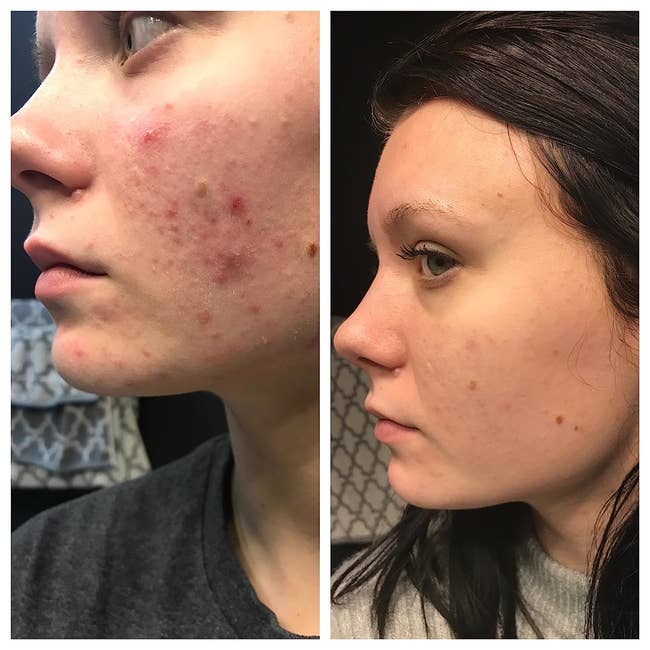 on the left, a reviewer with acne on their cheek and, on the right, the same reviewer with much of the acne cleared up 