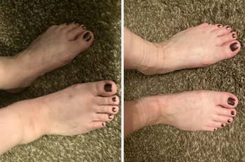 Comparison of 2  pairs of feet, showing results earlier  and aft  utilizing a ft  attraction   product. Both amusement   painted toenails