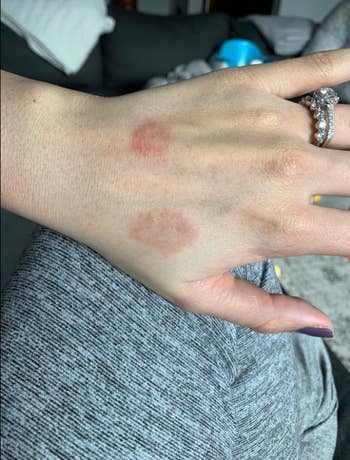 back of reviewer's hand with two painful looking patches of rash