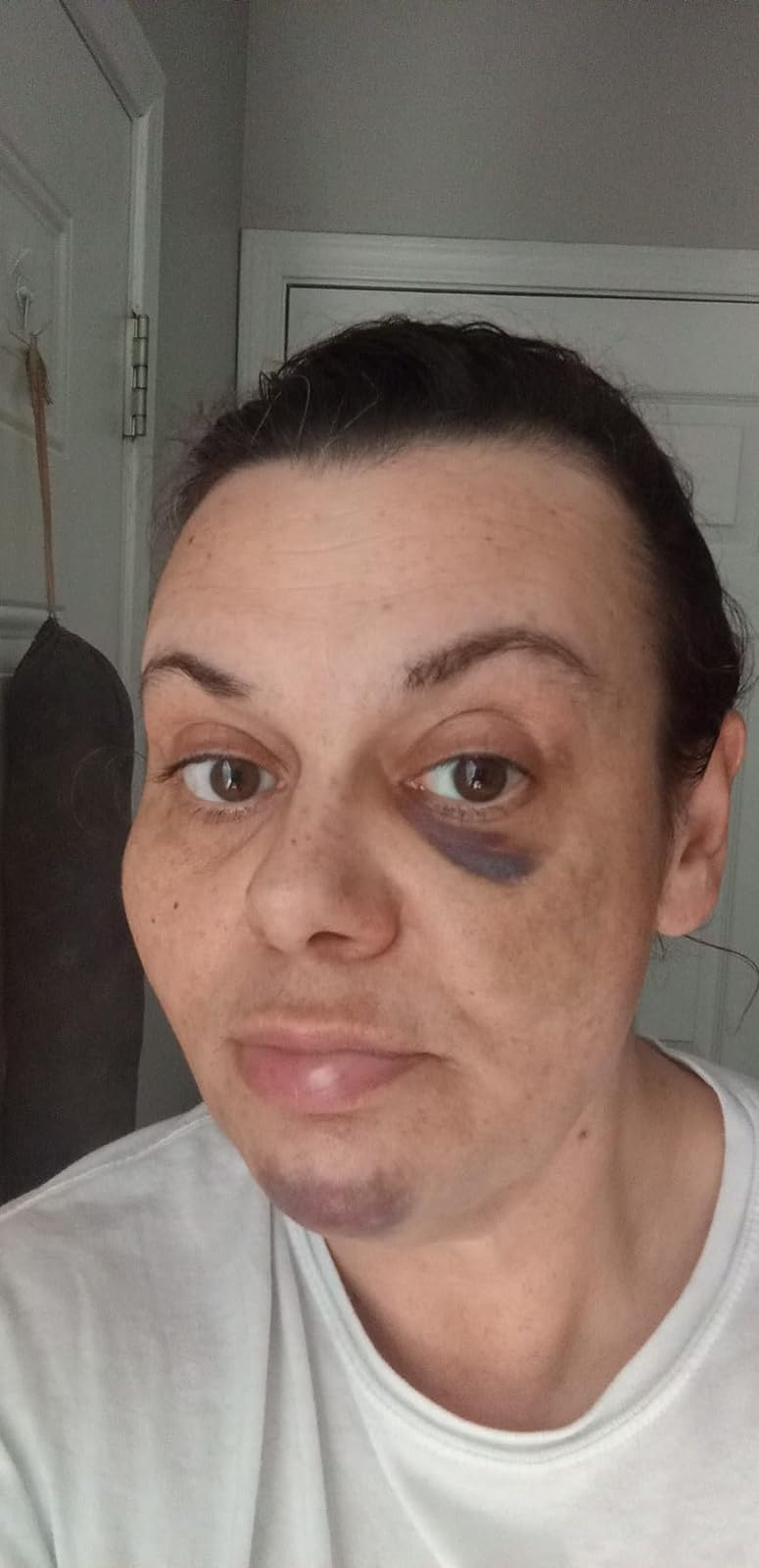 reviewer with acheronian  marks connected  their face