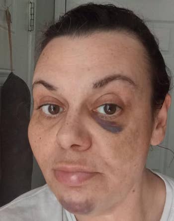 reviewer with acheronian marks connected their face