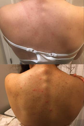 before and after photo showing the body was cleared up a reviewer's backne