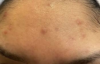 Close-up of a forehead with acne blemishes, showcasing skincare concerns