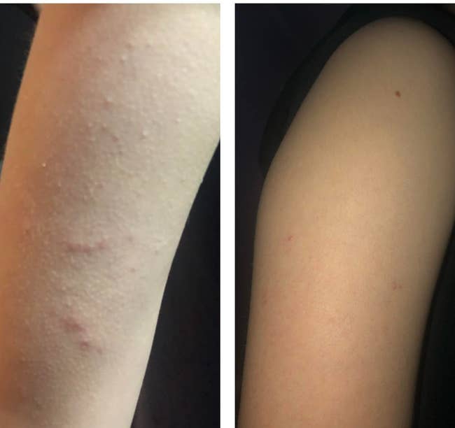 A reviewer's arm with a breakout before using the body wash, and after, clear