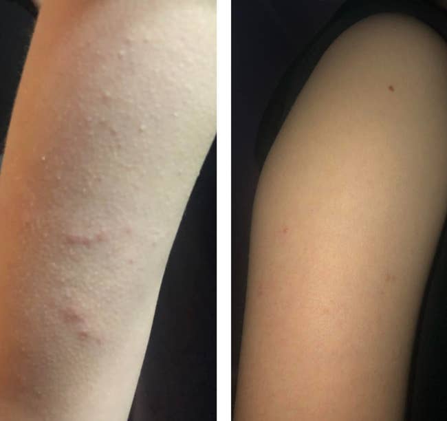 A reviewer's arm with a breakout before using the body wash, and after, clear