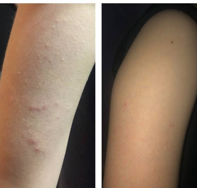 before and after showing the body wash totally cleared up the reviewer's arm bumps and breakouts
