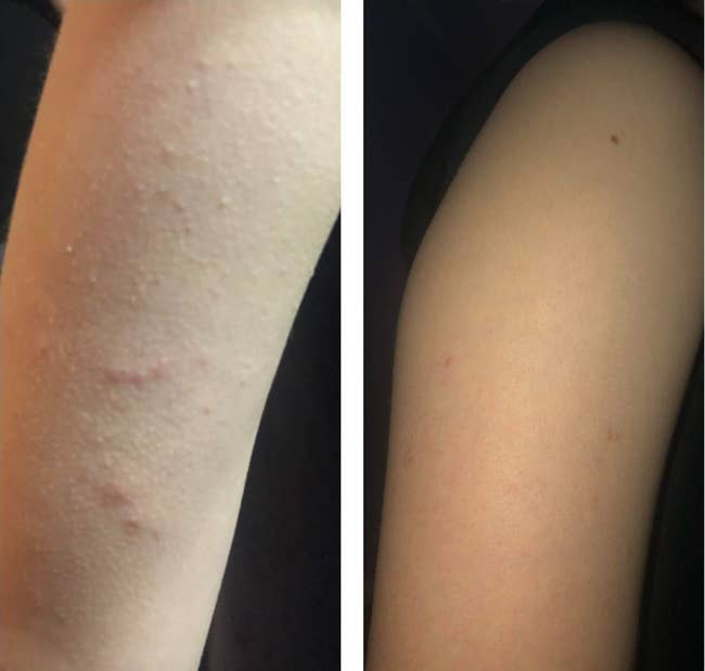 before and after showing the body wash totally cleared up the reviewer's arm bumps and breakouts