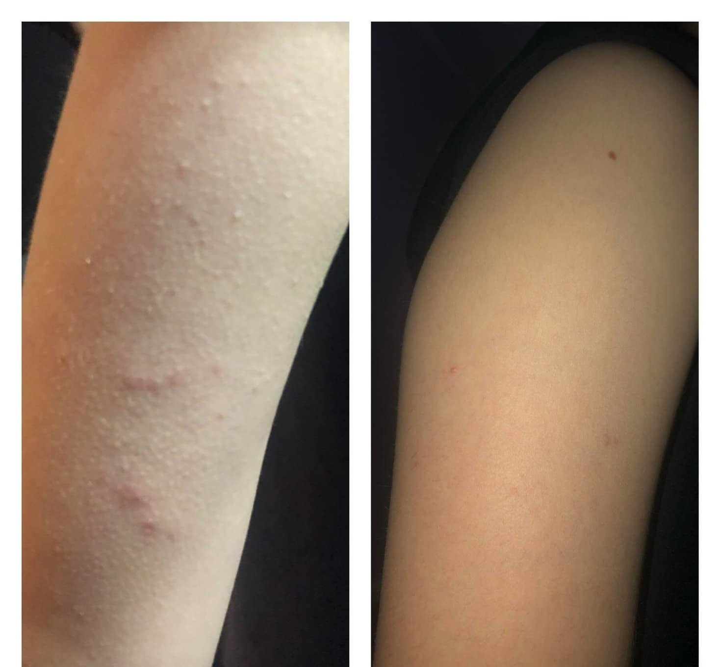 before and after showing the body wash totally cleared up the reviewer's arm bumps and breakouts