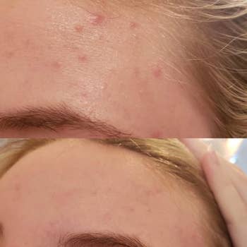 Reviewer acne before and after using patch