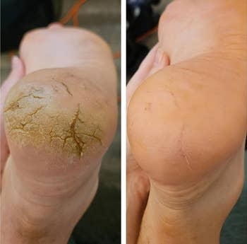 reviewers foot before and after using callus remover