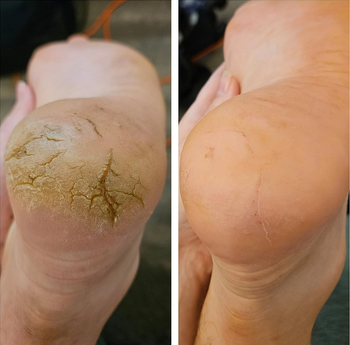 reviewers foot before and after using callus remover