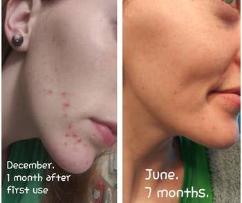 Reviewer showing results of using Cerave cleanser