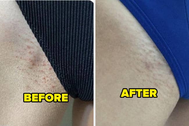 Before and after image of thighs in swimwear, showing reduced skin blemishes on the right