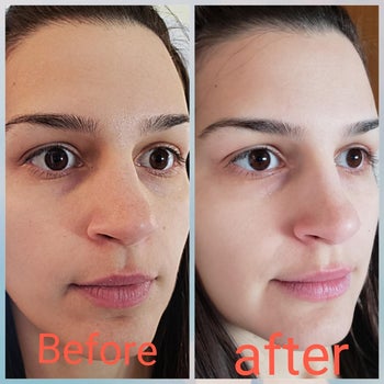 reviewer's before and after using the mask with their pores significantly decreased after