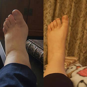 before and after photos of a reviewer's foot looking very swollen before using the socks, and much less swollen after