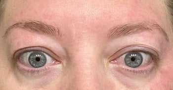 after image of same reviewer's slightly less dark and puffy under eyes