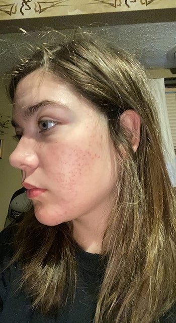 The same reviewer with fewer scars after using the product