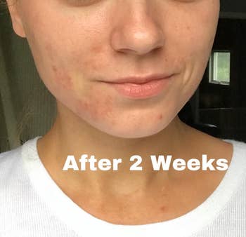 Reviewer's more clear-looking skin after two weeks of using the cream