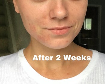 Reviewer's more clear-looking skin after two weeks of using the cream