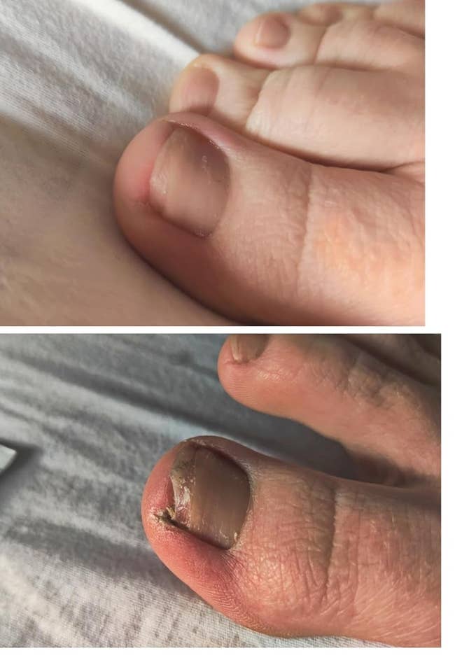 before and after of a reviewer's fungus-ridden toe becoming cleared up