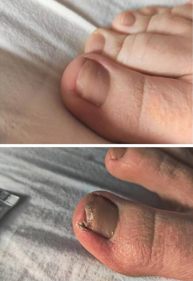 before and after images of a reviewer's fungus-ridden toe becoming cleared up