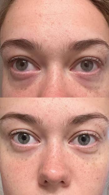 before and after comparison of reviewer's eyes before and after using under eye patches