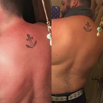 Reviewer photo of back before and after using Sunburnt