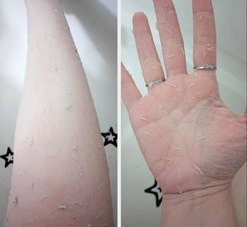 Close-up images of peeling tegument connected a person's limb and hand, perchance aft sunburn oregon utilizing a skincare product