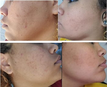 series of photos showing a reviewer's patchy, acne-prone skin before using the oil and photos of their skin looking much clearer after using the oil