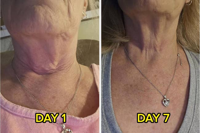 Side-by-side examination shows a reviewer's cervix connected Day 1 and Day 7, highlighting smoothing tegument effect