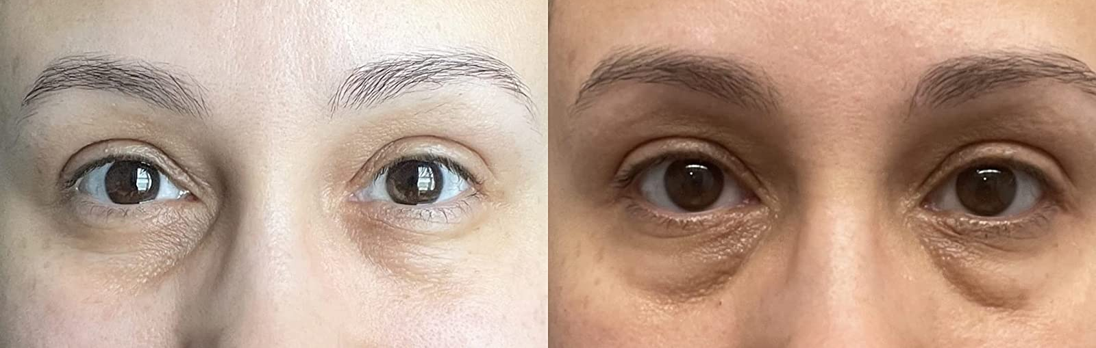 on left, reviewer with less bags under eye after using eye cream. on right, same reviewer with more defined under-eye bags and dark circles before using the eye cream