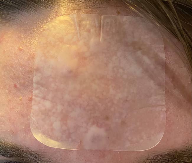 Reviewer wearing the XL pimple spot  connected  their forehead, with the spot  pulling retired  tons of achromatic  gunk from their skin