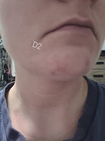 Reviewer's blemish after using blemish balm