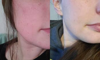 another reviewer's before and after photo showing red, irritated skin and then clear, smooth skin