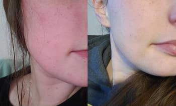 another reviewer's before and after photo showing red, irritated skin and then clear, smooth skin