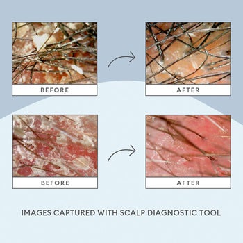 before and after photos showing scalps looking dry and flaky before using the treatment, and the same scalps without flakes after using the treatment