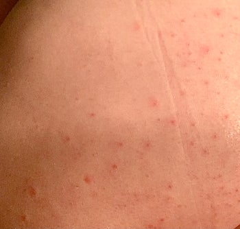 a reviewer photo of their skin with many blemishes 